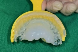 product_Immediate implant restoration03